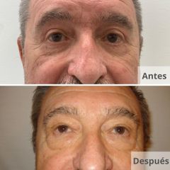 Blefaroplastia - Clínica Planas