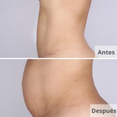 Lipo Vaser HD - Clínica Planas