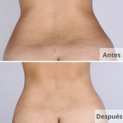 Lipo Vaser HD + abdominoplastia - Clínica Planas