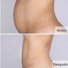 Lipo Vaser HD + abdominoplastia - Clínica Planas