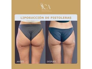 Liposucción - ICA, Instituto de Cirugía Avanzada