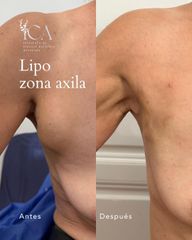 Lipo zona axila