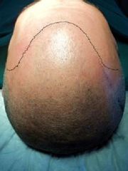 Trasplante De Cabello F.U.E.