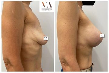 Aumento de pecho - Dr. Vernetta