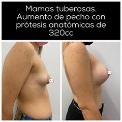 Aumento de pecho - Dr. Vernetta