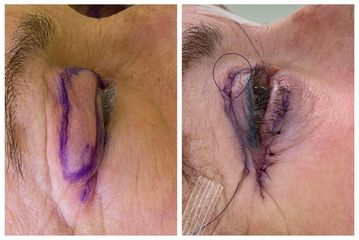 Blefaroplastia - Dr. Vernetta