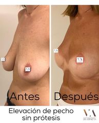 Mastopexia - Dr. Vernetta