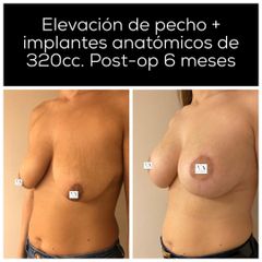Aumento de pecho - Dr. Vernetta