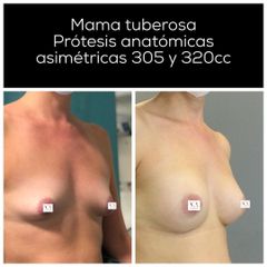 Aumento de pecho - Dr. Vernetta