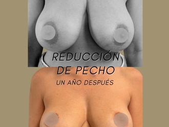 Reducción senos antes y después - 877830