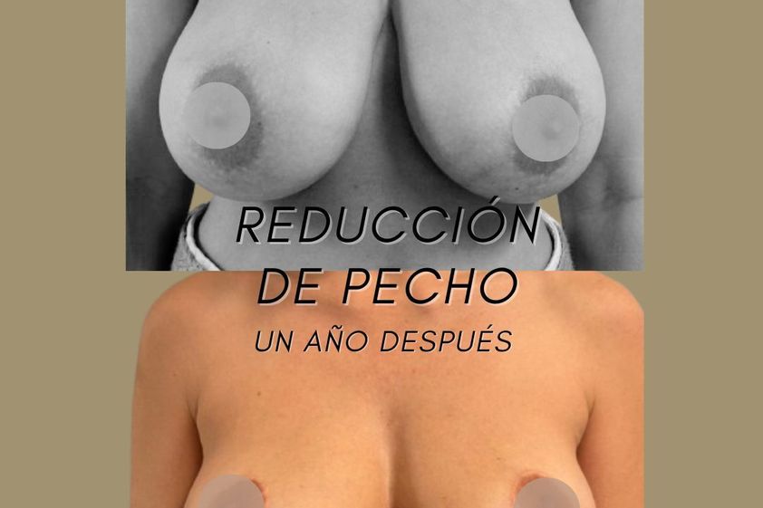 Reducción senos antes y después - 877830