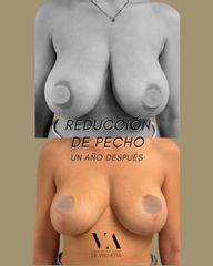 Dr. Vernetta - Reducción de senos