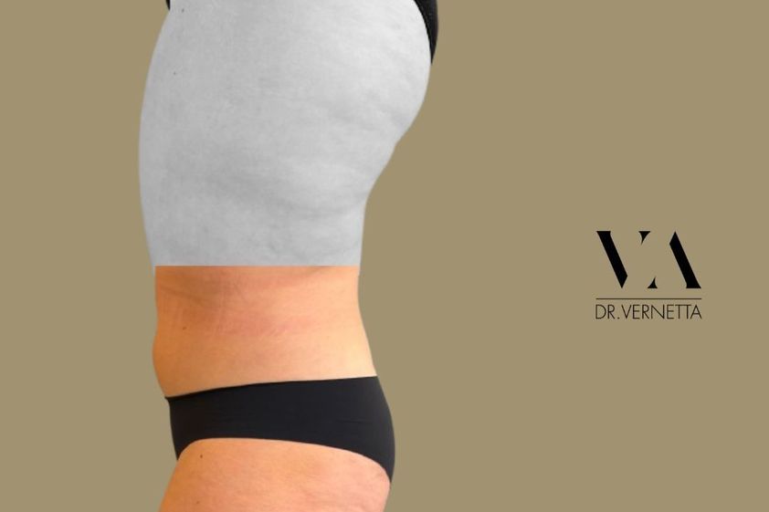 Lipoescultura antes y después - 877851
