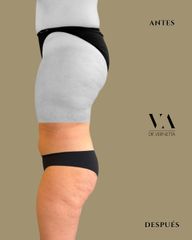Dr. Vernetta - Lipoescultura