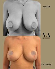 Dr. Vernetta - Mastopexia
