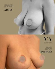 Dr. Vernetta - Mastopexia