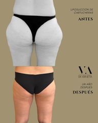 Dr. Vernetta - Liposucción