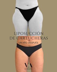 Dr. Vernetta - Liposucción