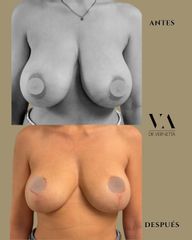 Dr. Vernetta - Mastopexia