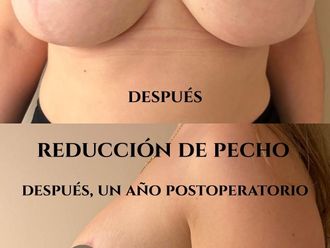 Reducción senos antes y después - 879159