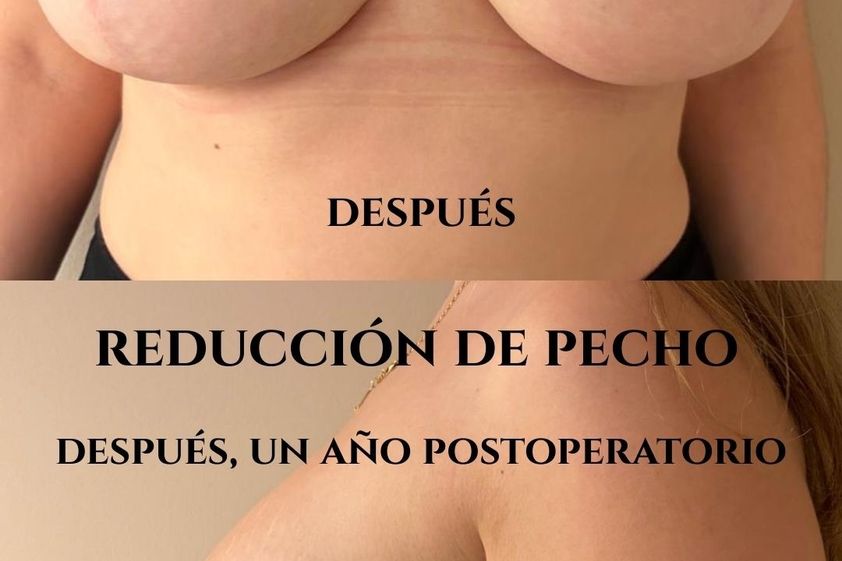 Reducción senos antes y después - 879159