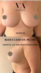 Reducción de pecho