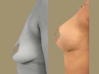 Mastopexia antes y después - 879160
