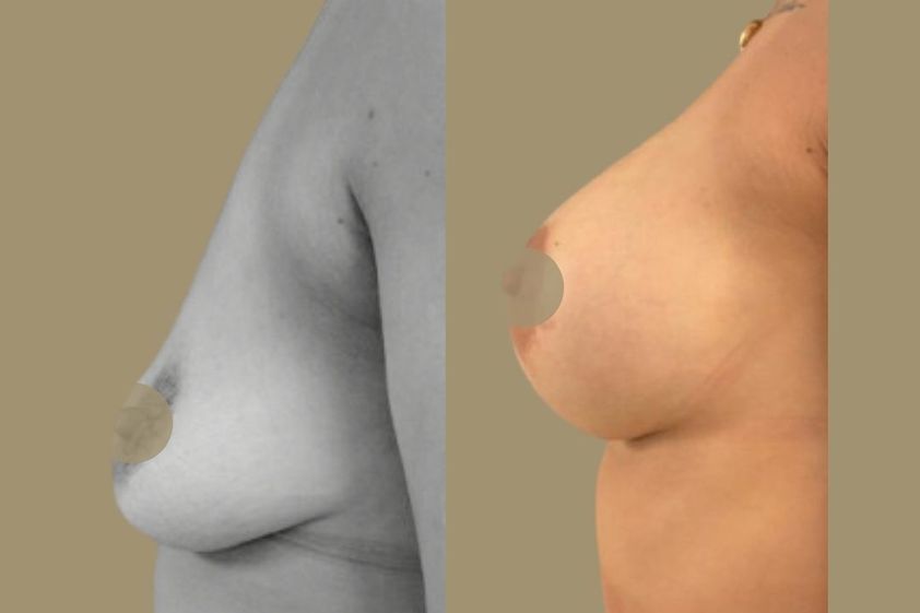 Mastopexia antes y después - 879160