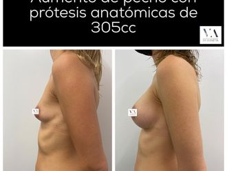 Aumento de pecho antes y después - 881455