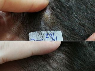 Antes y después Eliminación de lesión cutánea de cuero cabelludo