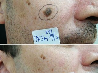 Antes y después Eliminación de lesión cutánea facial