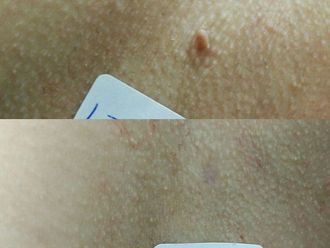 Verrugas - 615250