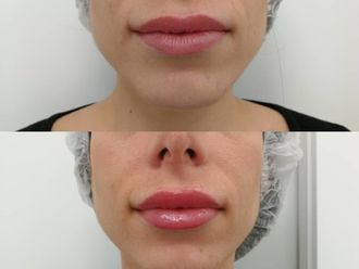 Aumento labios - 638700