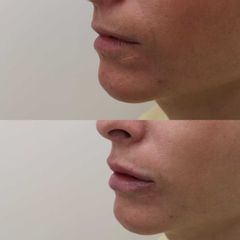 Antes y después Relleno de labios con ácido hialurónico - Clínica Bedoya