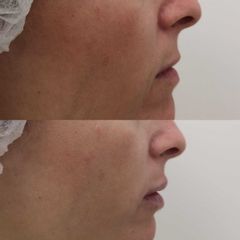 Antes y después Relleno de labios con ácido hialurónico - Clínica Bedoya