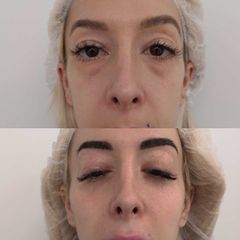 Antes y después  Eliminación de ojeras - Clínica BedoyaClínica Bedoya