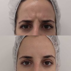 Antes y después con el tratamiento para las arrugas de expresión- Clínica Bedoya