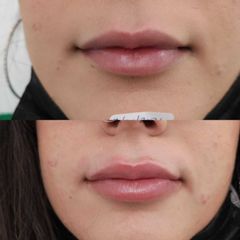 Relleno de labios con ácido hialurónico - Clínica Bedoya