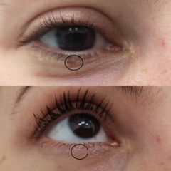 Eliminación de verruga- Clínica Bedoya
