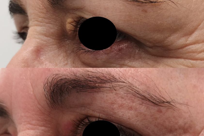 Xantelasmas antes y después - 808524