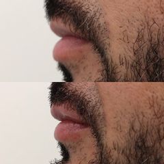 Relleno de labios con ácido hialurónico- Clínica Bedoya