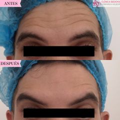Tratamiento anti arrugas - Clínica Bedoya
