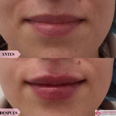 Hidratación de labios- Clínica Bedoya