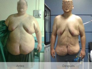 Antes y después Balón intragástrico