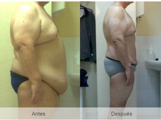 Antes y después Balón intragástrico