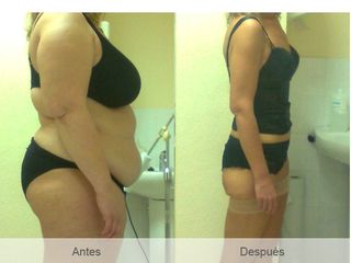 Antes y después Balón intragástrico