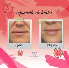 Antes y después Aumento de labios en Clínica Rubianes (Antes y después)