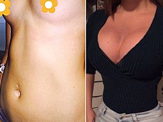 Antes y después Aumento de mama y lipoescultura