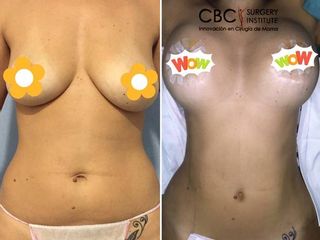 Antes y después Lipoescultura de abdomen y flancos, y mastopexia con implantes