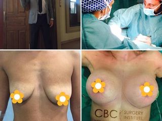 Antes y después Mastopexia con implantes